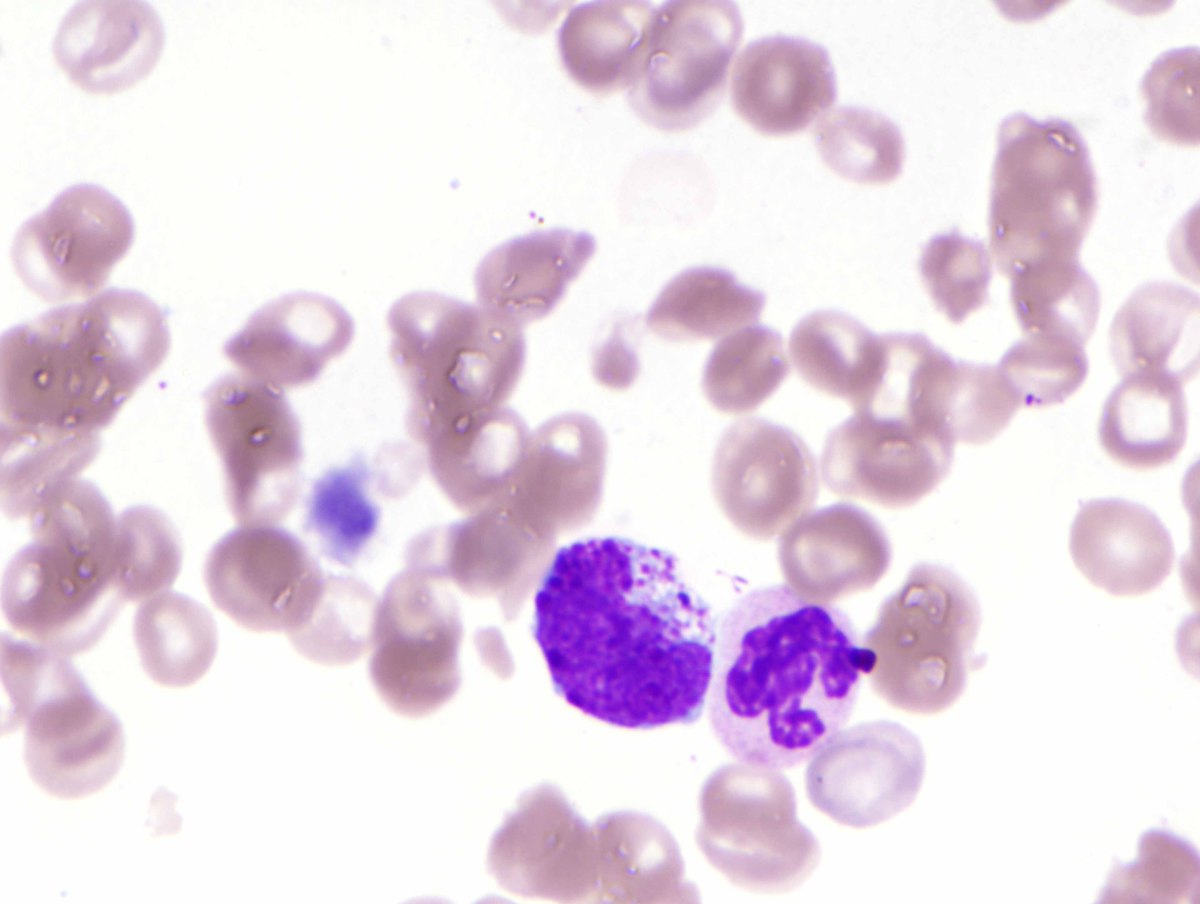 B) Peripheral blood smear with marked basophilia (#2), (Wright stain, 1000x)